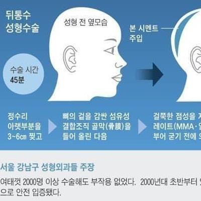 무시무시한요즘성형수술.jpg